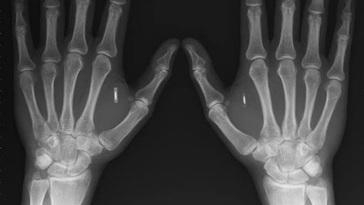 Na Suécia, 3 mil pessoas já usam microchips sob a pele